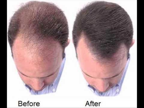 can a healthy diet regrow hair